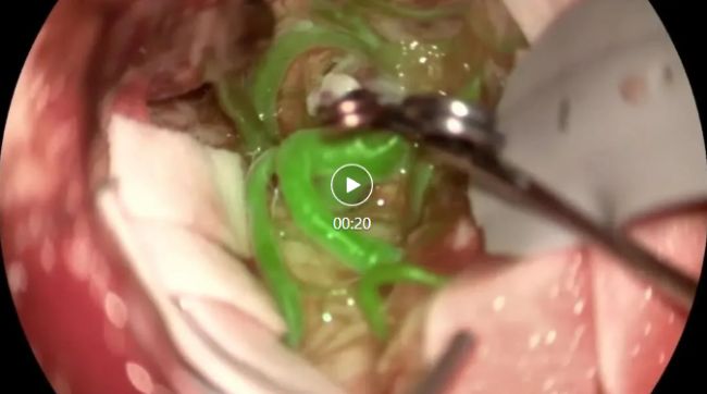 显微课堂 | 荧光在血管神经外科中的应用前景